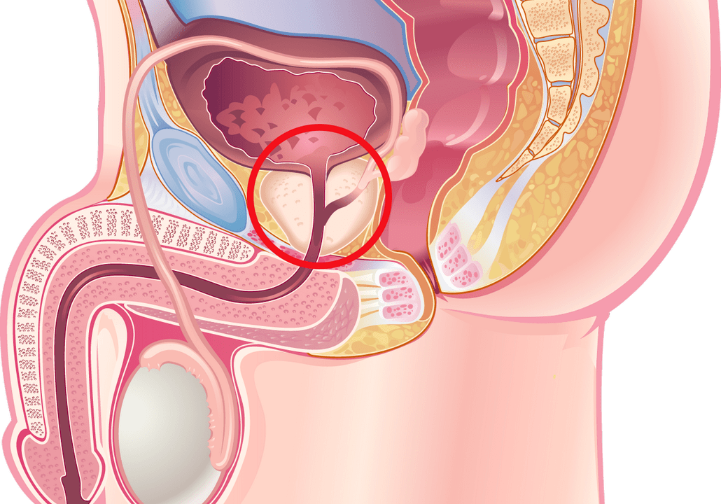 prostatitis symptoms and signs